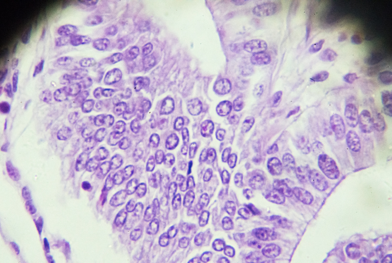 What is Adenomyosis?